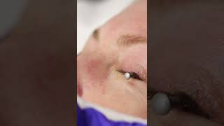 Eye Wrinkles Treatment with Ablative Co2 Laser [upl. by Giverin]