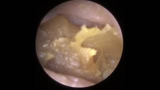 789  Fully Blocked Impacted Ear Wax Removal [upl. by Howell]