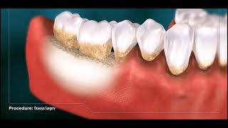 Osseous Recontouring Surgery [upl. by Bax]