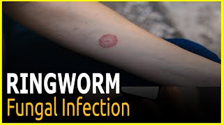 Ringworm What to know and do ringowrm treatments medicine [upl. by Inverson]