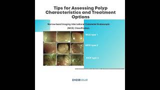 Tips for Assessing Polyp Characteristics and Treatment Options [upl. by Kramlich]