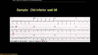 1215 Lead ECG Sample of an Old MI [upl. by Julienne]