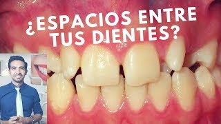 Cómo cerrar los espacios entre los dientes Diastemas dentales [upl. by Krutz]