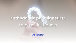 Orthodontie invisible par aligneurs  la pose de taquets [upl. by Ivo]