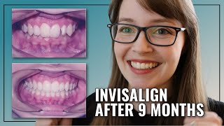 INVISALIGN BEFORE amp AFTER  Deep Bite  Crowding Treatment [upl. by Wier791]