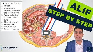 Anterior lumbar interbody fusion ALIF  Step by step procedure details anatomy amp recovery review [upl. by Holna]