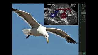 ULTRASOUND GUIDED CELIAC PLEXUS BLOCK USG [upl. by Nylasor]