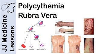 Polycythemia Rubra Vera  Pathophysiology Symptoms Diagnosis and Treatment [upl. by Helsell]