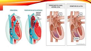 22 Cardiopathies Congénitales Dr Benlalam Parnet  Cardio [upl. by Earissed]