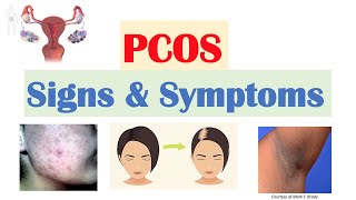 Polycystic Ovary Syndrome PCOS Signs amp Symptoms  amp Why They Occur [upl. by Sadie434]