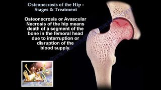 Osteonecrosis Of The Hip Stages amp Treatment  Everything You Need To Know  Dr Nabil [upl. by Saunderson]