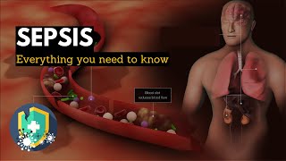 Sepsis Everything You Need to Know [upl. by Ynnek]