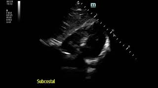 Severe Pleuritic MidChest Pain in 17 yo Boy Pneumomediastinum [upl. by Elijah]