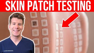 ALLERGY TESTING Doctor explains the Skin Patch Test [upl. by Alehs]