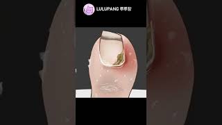 내성발톱 Ingrown Toenail Shorts [upl. by Lauhsoj]