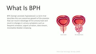 UroLift for BPH [upl. by Scoter]