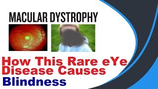 Macular Dystrophy hindi [upl. by Peednus]