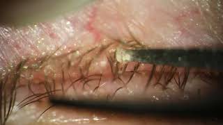 Severe Demodex Removal on 75yearold [upl. by Korwin814]