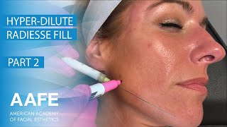 HyperdiluteDilute Radiesse Fill Pt2 [upl. by Small]