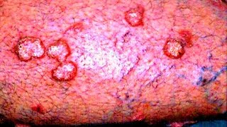 Lichen Planus  Medical PowerPoint Presentation [upl. by Notnarb]