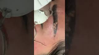 ND YAG Laser Eyebrows Tattoo removal hairremoval tattoo pimplepatch laser [upl. by Anaek679]