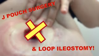 J Pouch Surgery and Loop ileostomies [upl. by Azrim]