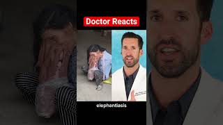 ER Doctor REACTS to Elephantiasis [upl. by Iclek856]