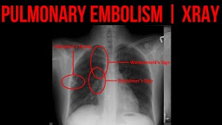 PULMONARY EMBOLISM  XRAY FINDINGS  ALL DIFFERENTIALS [upl. by Hcardahs850]