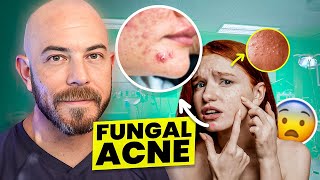 Fungal acne on the face and body QampA with Dr Dray [upl. by Hwu]