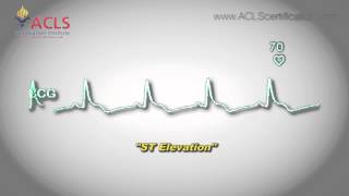 ST Elevation by ACLS Certification Institute [upl. by Zerep]