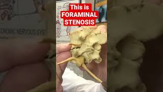 What FORAMINAL STENOSIS Really Looks Like Must See  Dr Walter Salubro [upl. by Lenora]