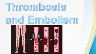 Thrombosis amp Embolism  Virchows triad  Pulmonary Embolism  Types of Embolus  Venous Thrombi [upl. by Yenreit]