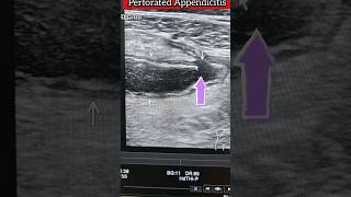 Acute Appendicitis with Perforation medical health infection appendicitis ultrasound viral [upl. by Sladen]