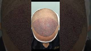 3000 grafts Hair Transplant for Hairline Restoration [upl. by Liane]