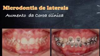 Microdontia dos laterais  Prof Dr Pedro Andrade Jr [upl. by Esil507]