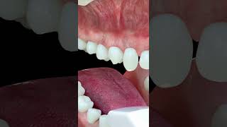 Video 3D Tratamiento de Invisalign  Ortodoncia invisible con taches [upl. by Beckerman147]