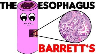 Esophagus Histology  3 Barretts Esophagus [upl. by Dunning]