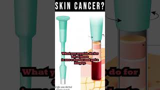 Skin Cancer Dont Ignore The Warning Signs [upl. by Horter]