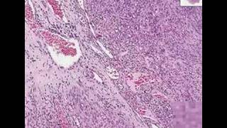 Histopathology SkinKaposi sarcoma [upl. by Aiam740]