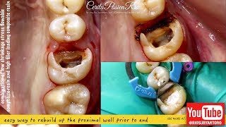 EASY REWALLING voco xtrabase grandioso heavy flow composite resin endodontic treatment [upl. by Annoyk]