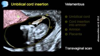 Velamentous insertion of the umbilical cord [upl. by Yrrep]