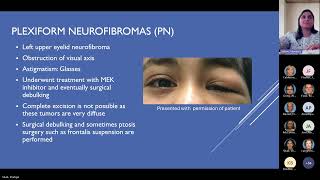 Pediatric Manifestations of Neurofibromatosis Type 1 Pediatric Grand Rounds Meeting 11 15 24 [upl. by Nysila]