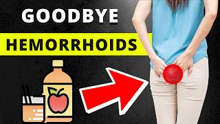 7 Home Remedies to Get Rid of Hemorrhoids and Prevent Them [upl. by Steffie203]