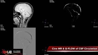 Cine MR amp Q FLOW CSF Circulation [upl. by Kostival]