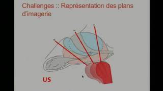 Biopsies prostatiques avec fusion d’images sous système KOELIS [upl. by Ahseila]