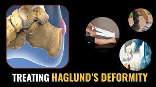 How to TREAT Haglunds Deformity Home Treatments and Doctors Treatment Options 2021 [upl. by Dinesh]