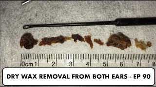 DRY EAR WAX REMOVAL FROM BOTH EARS  EP 90 [upl. by Drapehs508]