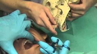 PosteriorSuperiorAlveolarNerveBlockflv [upl. by Abbott]