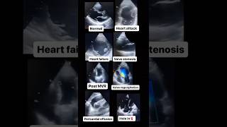 Echocardiogram NORMAL vs ABNORMAL radiology cardiology [upl. by Eliam]