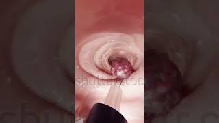 Colonoscopy ulcers colon medicalimagingcolonoscopy medicalanimation [upl. by Ferna]